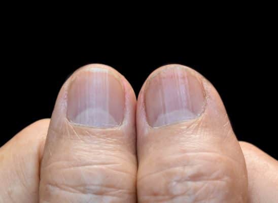 Strepen op nagels